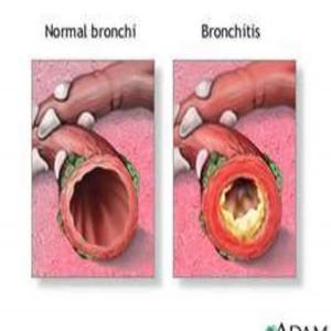 HERBAL EXPECTORANT FOR BRONCHITIS_image