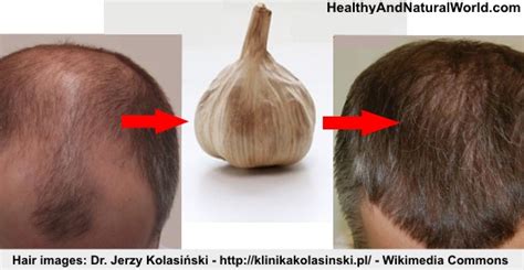 how-to-use-garlic-to-promote-hair-growth-research image