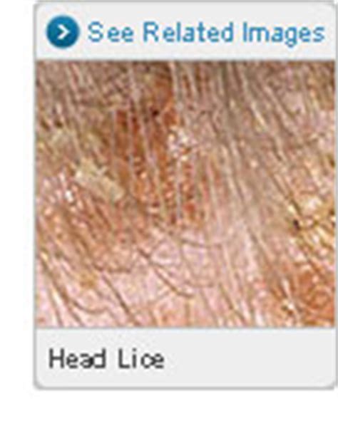 lice-and-scabies-treatments-shampoos-and-more image