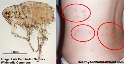 how-to-get-rid-of-flea-bites-quickly-and image