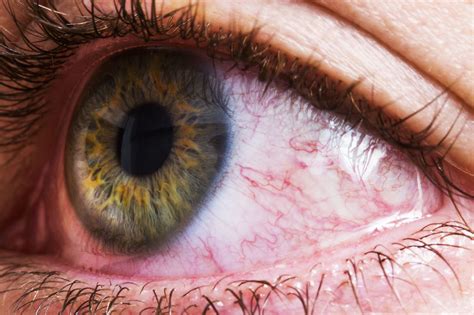 bloodshot-eyes-20-reasons-why-eyes-are-red-verywell image