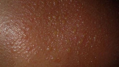 sunburn-blisters-symptoms-treatments-and image