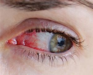 home-remedies-for-bloodshot-eyes-american image