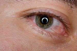 how-to-get-rid-of-bloodshot-red-eyes-naturally-without image
