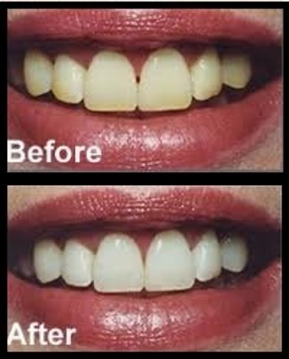 before-and-after-homemade-teeth-whitening-recipe-with image